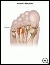 Thumbnail image of: Morton's Neuroma: Illustration