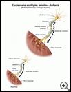 Thumbnail image of: Multiple Sclerosis--Damaged Myelin: Illustration