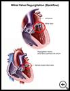 Thumbnail image of: Mitral Valve Regurgitation: Illustration