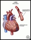 Thumbnail image of: Heart Attack: Illustration