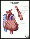 Thumbnail image of: Heart Attack: Illustration