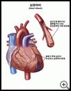 Thumbnail image of: Heart Attack: Illustration