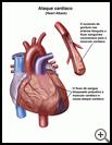Thumbnail image of: Heart Attack: Illustration
