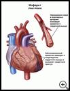 Thumbnail image of: Heart Attack: Illustration