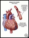 Thumbnail image of: Heart Attack: Illustration