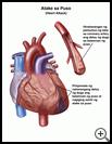 Thumbnail image of: Heart Attack: Illustration