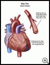 Thumbnail image of: Heart Attack: Illustration