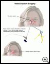 Thumbnail image of: Nasal Septum Surgery: Illustration