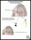 Thumbnail image of: Nasal Septum Surgery: Illustration