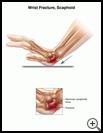 Thumbnail image of: Wrist Fracture, Scaphoid: Illustration