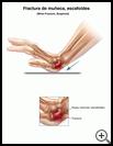 Thumbnail image of: Wrist Fracture, Scaphoid: Illustration