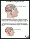 Thumbnail image of: Normal Pressure Hydrocephalus: Illustration