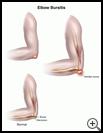 Thumbnail image of: Elbow Bursitis: Illustration