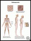 Thumbnail image of: Osteoporosis in Women: Illustration