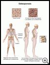 Thumbnail image of: Osteoporosis in Women: Illustration