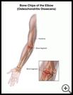 Thumbnail image of: Bone Chips in the Elbow (Osteochondritis Dissecans): Illustration