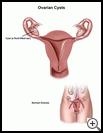 Thumbnail image of: Ovarian Cysts: Illustration