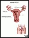 Thumbnail image of: Ovarian Cancer: Illustration