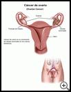 Thumbnail image of: Ovarian Cancer: Illustration