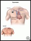 Thumbnail image of: Pacemaker: Illustration
