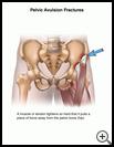 Thumbnail image of: Pelvic Avulsion Fracture: Illustration