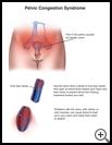 Thumbnail image of: Pelvic Congestion Syndrome: Illustration