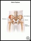 Thumbnail image of: Pelvic Fracture: Illustration
