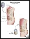 Thumbnail image of: Kidney Dialysis: Peritoneal Dialysis Illustration