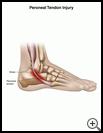Thumbnail image of: Peroneal Tendon Injury: Illustration