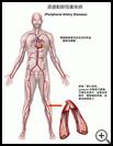 Thumbnail image of: Peripheral Artery Disease: Illustration