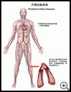 Thumbnail image of: Peripheral Artery Disease: Illustration