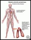 Thumbnail image of: Peripheral Artery Disease: Illustration