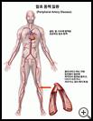 Thumbnail image of: Peripheral Artery Disease: Illustration
