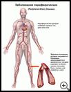 Thumbnail image of: Peripheral Artery Disease: Illustration