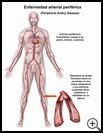 Thumbnail image of: Peripheral Artery Disease: Illustration