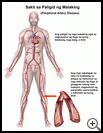 Thumbnail image of: Peripheral Artery Disease: Illustration