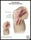 Thumbnail image of: Knee Bursitis (Pes Anserine Bursitis): Illustration