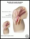 Thumbnail image of: Knee Bursitis: Illustration