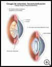 Thumbnail image of: Cataract Surgery with Phacoemulsification: Illustration