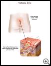 Thumbnail image of: Tailbone Cyst: Illustration