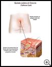 Thumbnail image of: Tailbone Cyst: Illustration