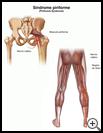 Thumbnail image of: Piriformis Syndrome: Illustration