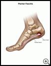 Thumbnail image of: Plantar Fasciitis: Illustration