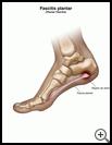 Thumbnail image of: Plantar Fasciitis: Illustration