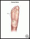 Thumbnail image of: Plantar Warts: Illustration