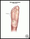 Thumbnail image of: Plantar Warts: Illustration
