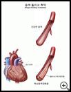Thumbnail image of: Plaque Buildup in Arteries: Illustration