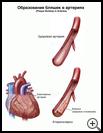 Thumbnail image of: Plaque Buildup in Arteries: Illustration