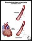 Thumbnail image of: Plaque Buildup in Arteries: Illustration