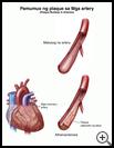 Thumbnail image of: Plaque Buildup in Arteries: Illustration